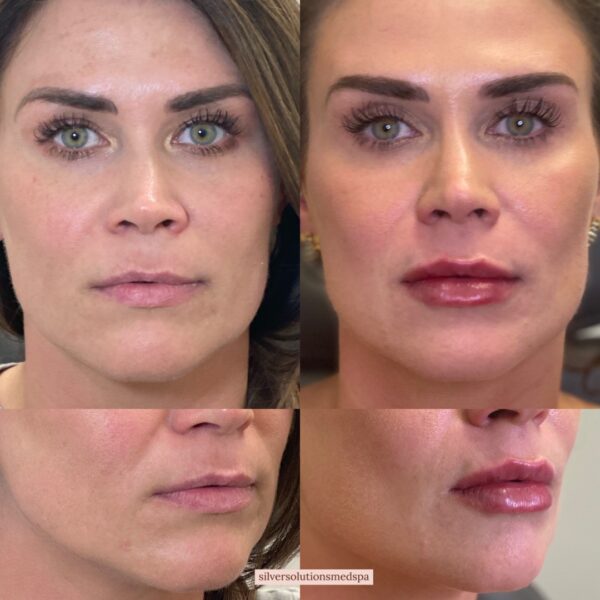 Lip Fillers Before After