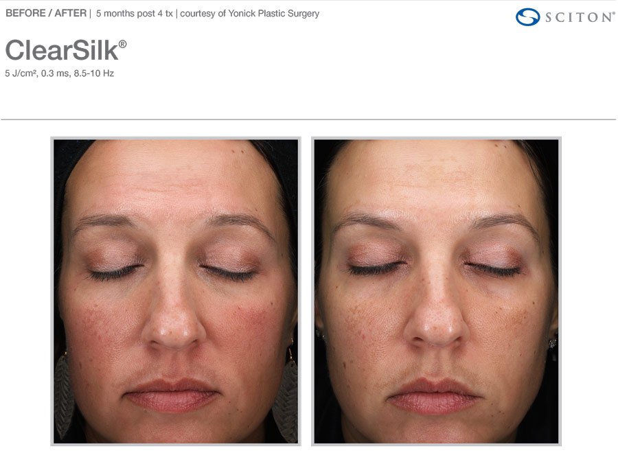 ClearSilk for Rosacea: Before and after