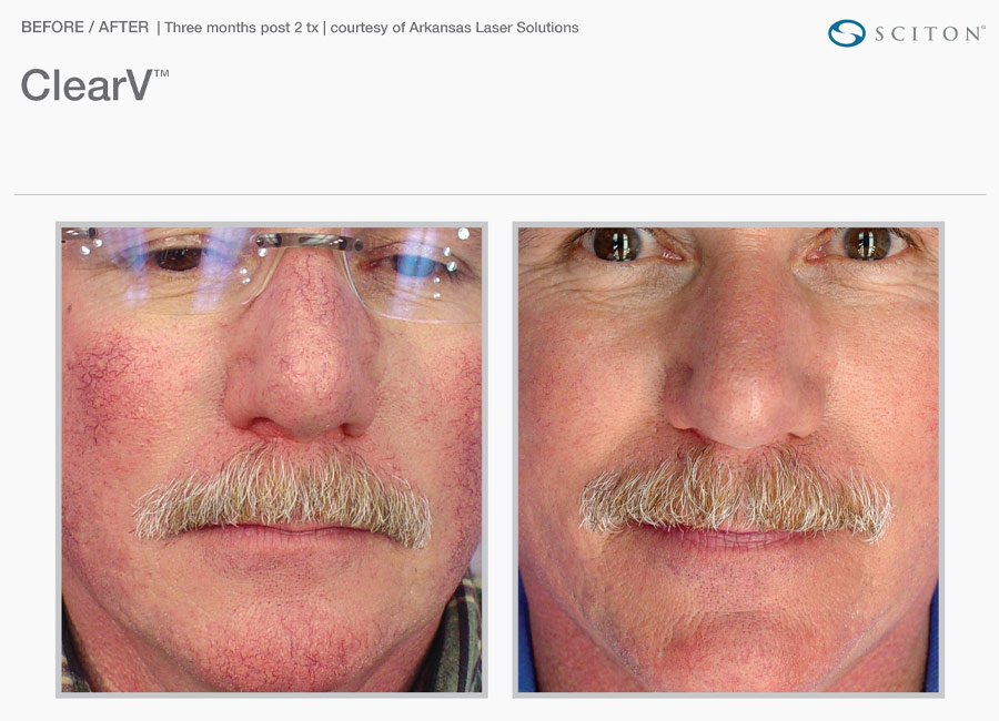 ClearV for Facial Veins: Before and after